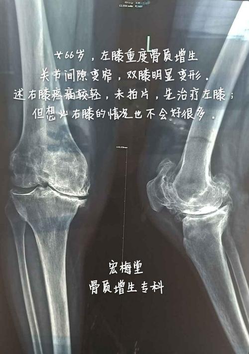 骨质增生x光片子怎么看