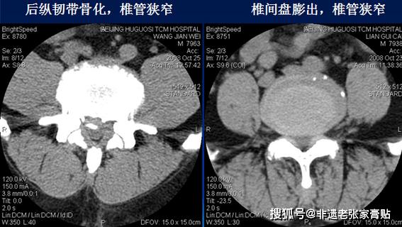 骨质增生ct显示啥意思