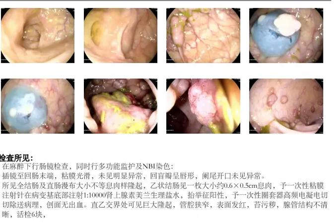 传性非息肉性结肠癌