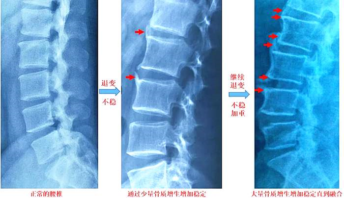 骨质增生V级是怎么回事