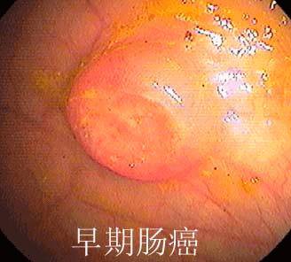 结肠癌早期的症状