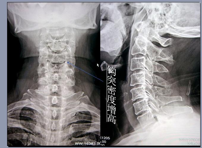 钩椎关节椎体缘骨质增生