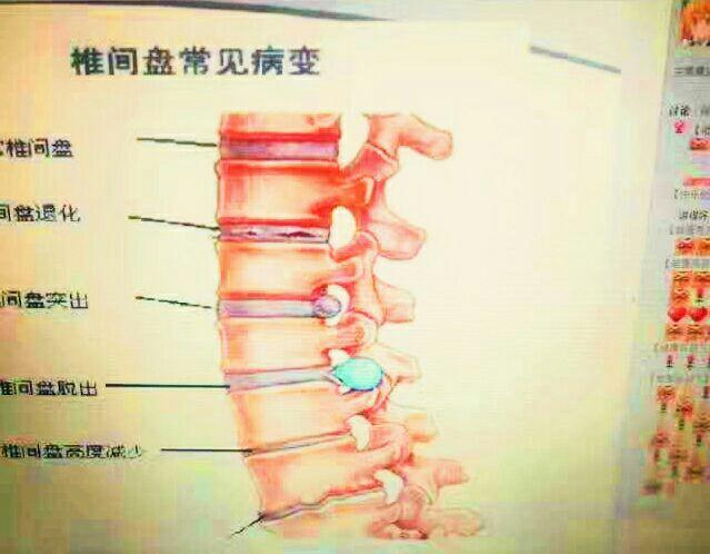 骨质增生变圆了怎么办呢