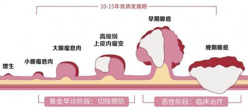 结肠癌早期的症状