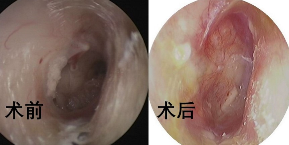 中耳炎穿孔自愈机会大吗