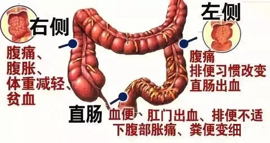 结肠癌的危害有哪些