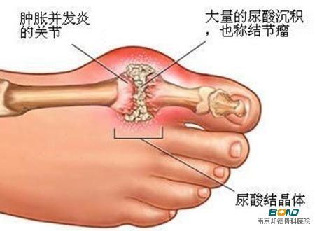 痛风关节僵硬吃药没效果