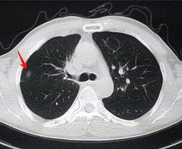 结核病变是什么意思