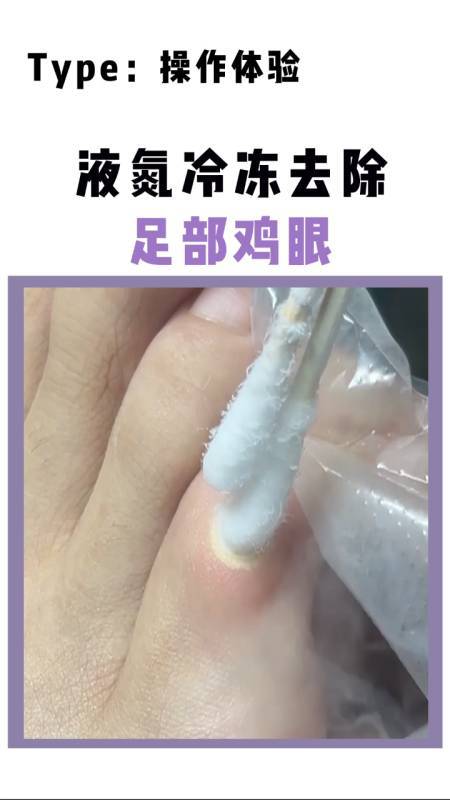 液氮冷冻鸡眼的正确方法