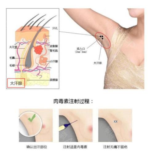 选择狐臭手术还是肉毒素