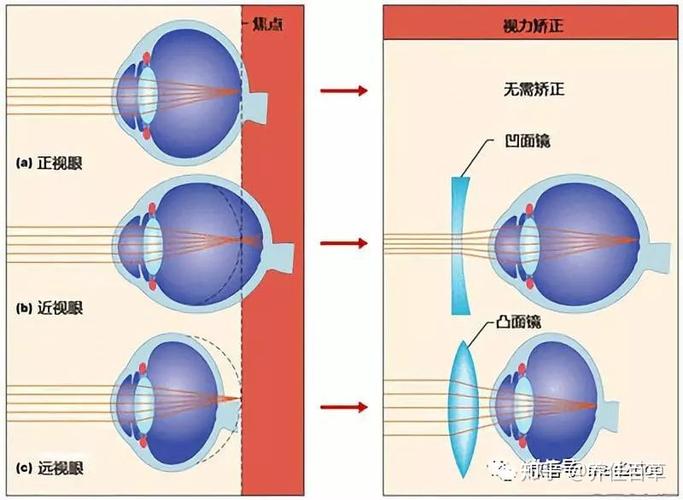 近视眼是怎么回事