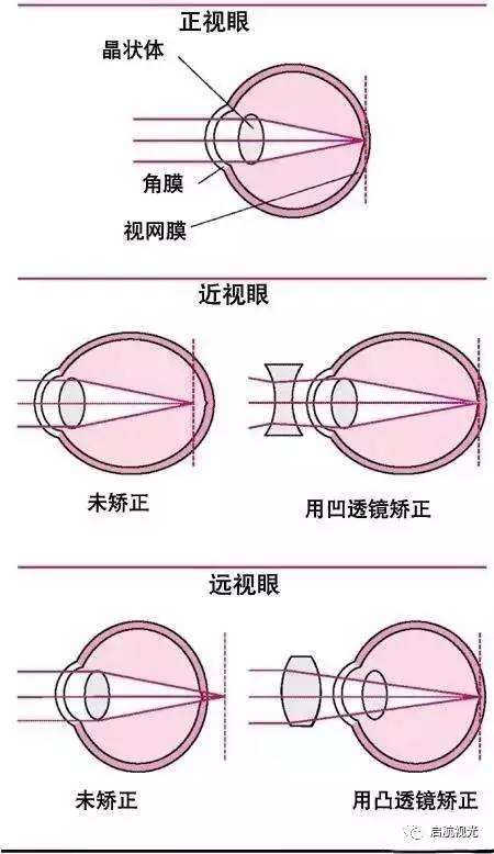 近视眼是怎么回事