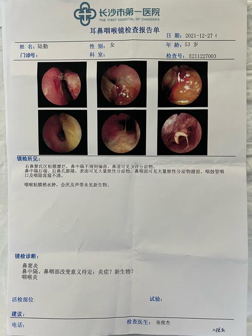 鼻型淋巴癌发烧什么原因