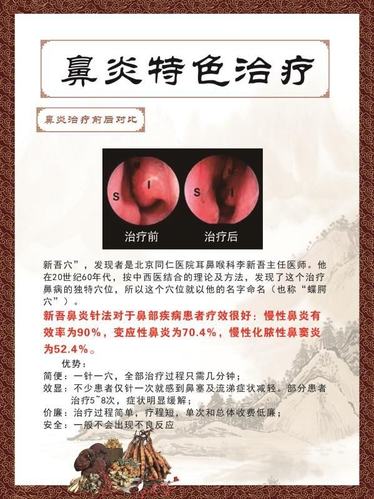 怎么彻底治好过敏性鼻炎