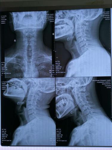 颈椎骨质增生拍片怎么看