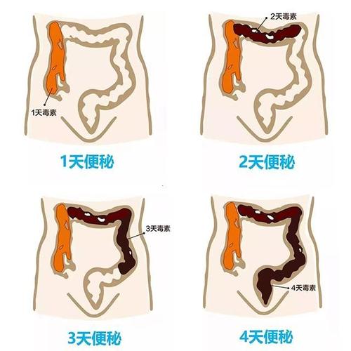 便秘口臭小腿抽筋