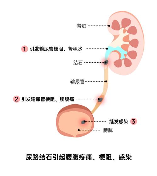 输尿管结石疼痛症状