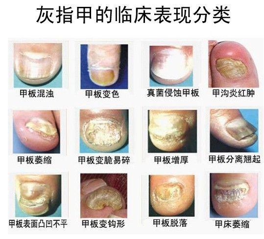 怎么看自己指甲是灰指甲