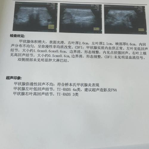 甲状腺癌刀口大小一样吗