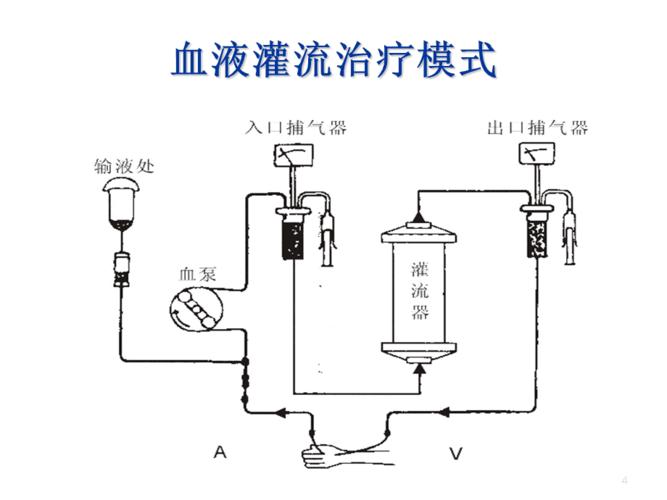 血液灌流治疗类风湿