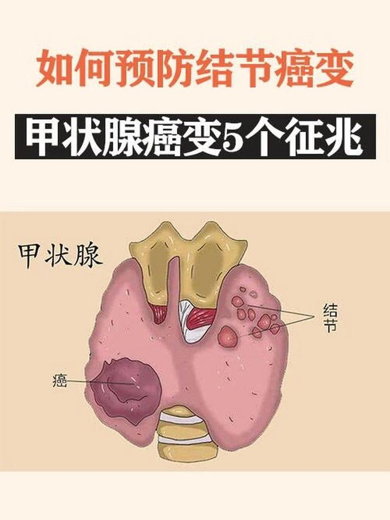 甲状腺癌不吃药会怎么样