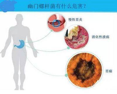 什么胃病会导致口臭