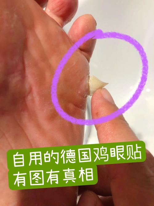 要怎么样才能去掉鸡眼呢