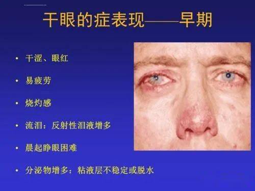 眼泪挺多的会是干眼症吗