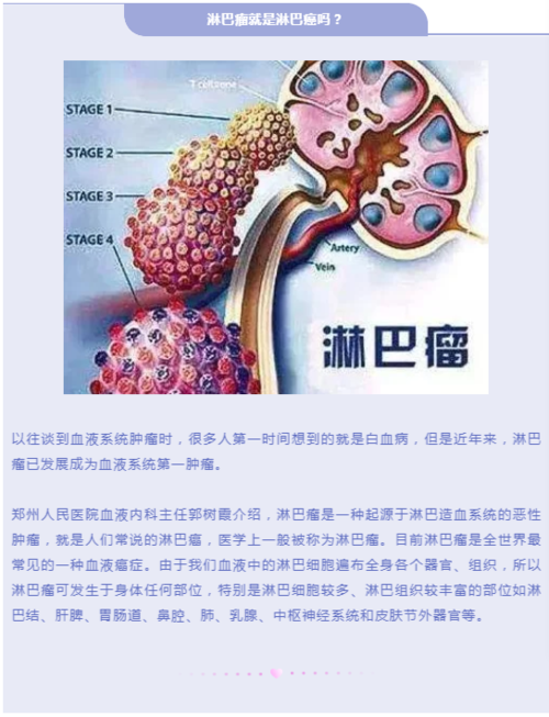 怎么判断淋巴瘤和淋巴癌