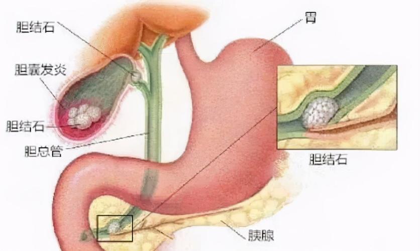 胆囊炎和痢疾的区别