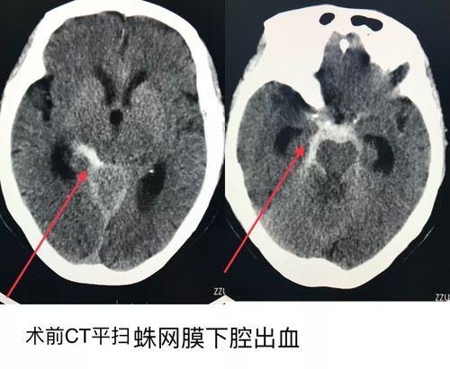 脑出血几年会复发