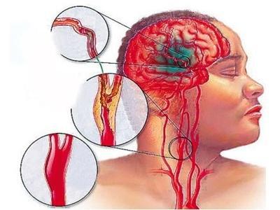 急性脑血栓的症状