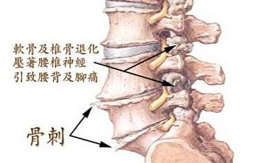 颈椎骨质增生可以转头吗