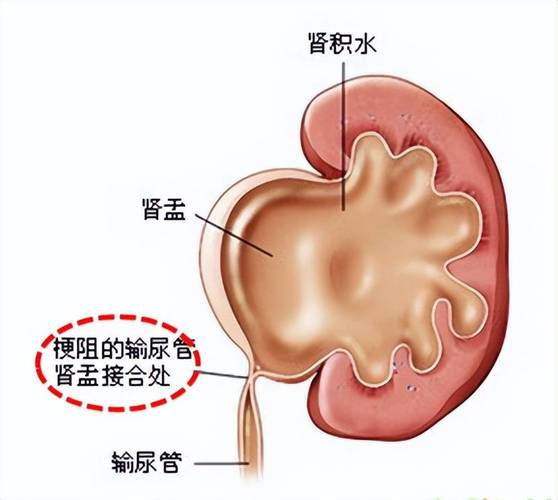 左边的肾检查出来肾积水