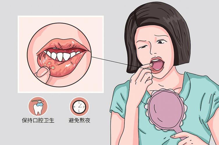 怎样治疗口腔溃疡效果好