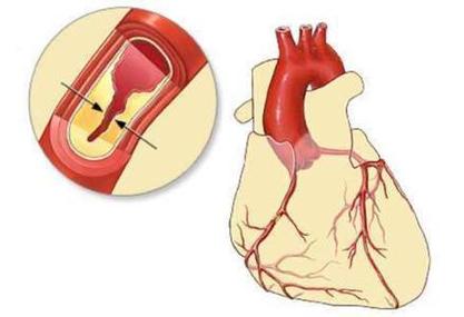 贫血与心肌缺血有关系吗