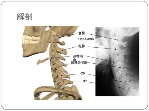 颈椎间盘轻微突出偏头痛