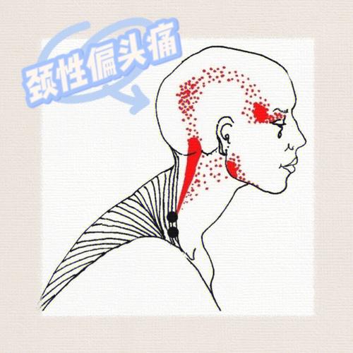 颈椎间盘轻微突出偏头痛