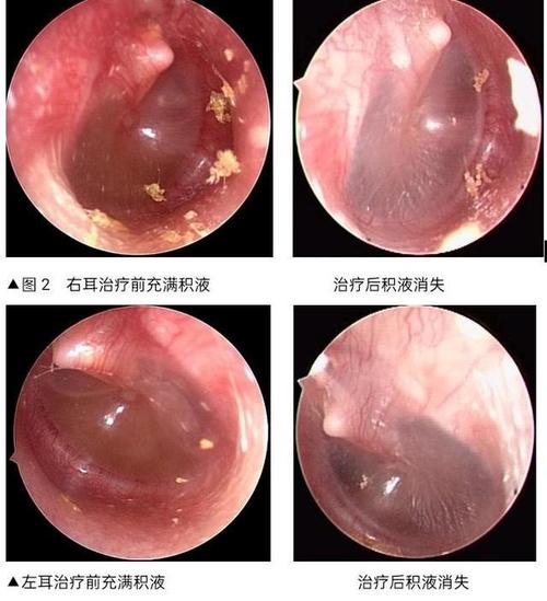 急性化脓性中耳炎的检查