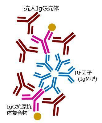 牙周炎影响类风湿因子吗