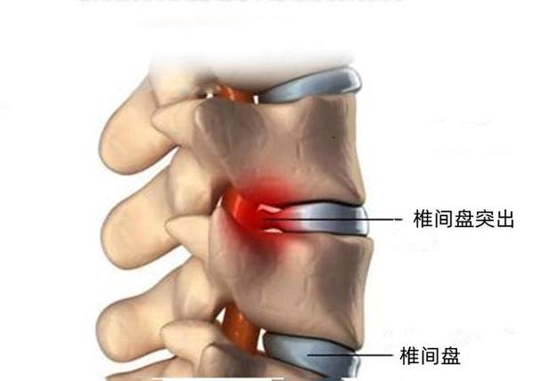 颈椎间盘轻微突出偏头痛