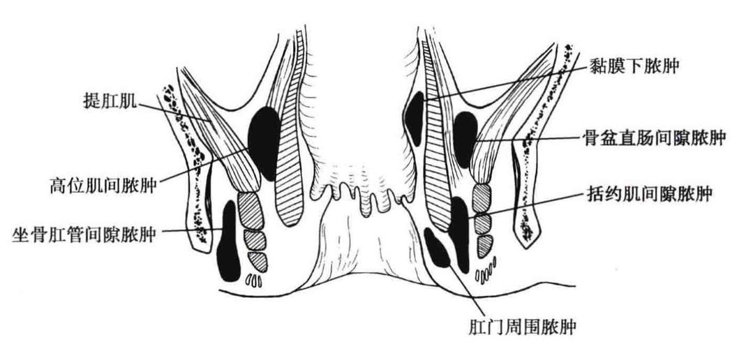 肛周炎结肠炎是什么原因