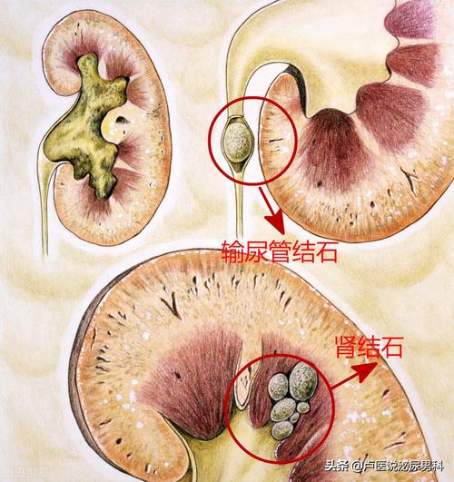 肾结石和肾盂结石是什么