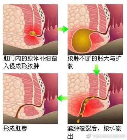 肛周炎结肠炎是什么原因