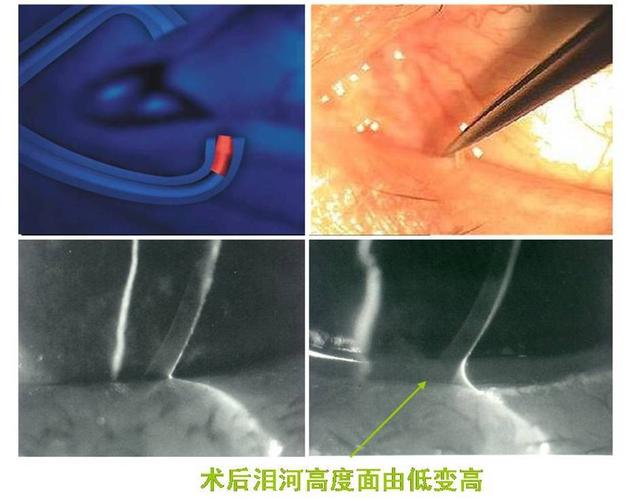 眼裂隙灯能查出干眼症吗