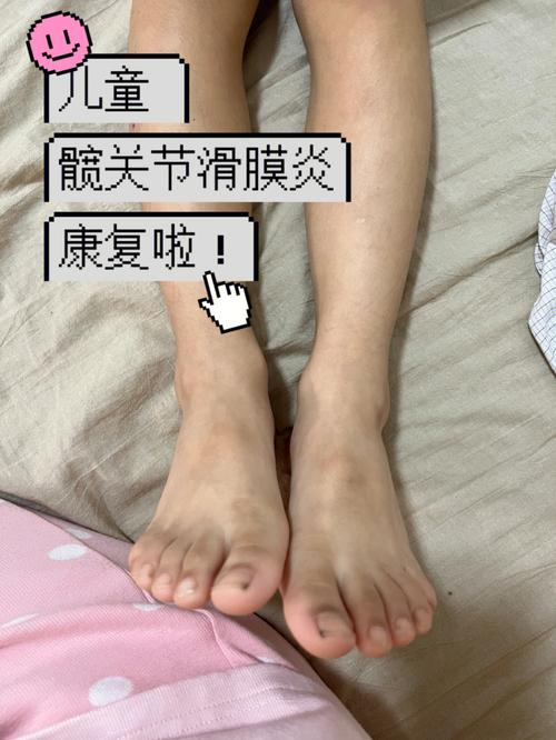 小儿髋关节滑膜炎严重吗