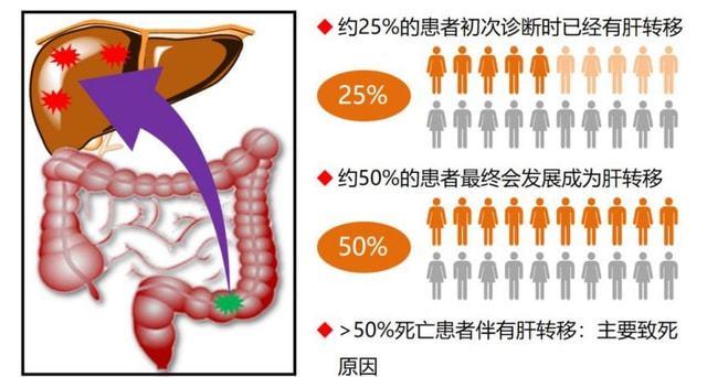 结肠癌转移肝可以治愈吗