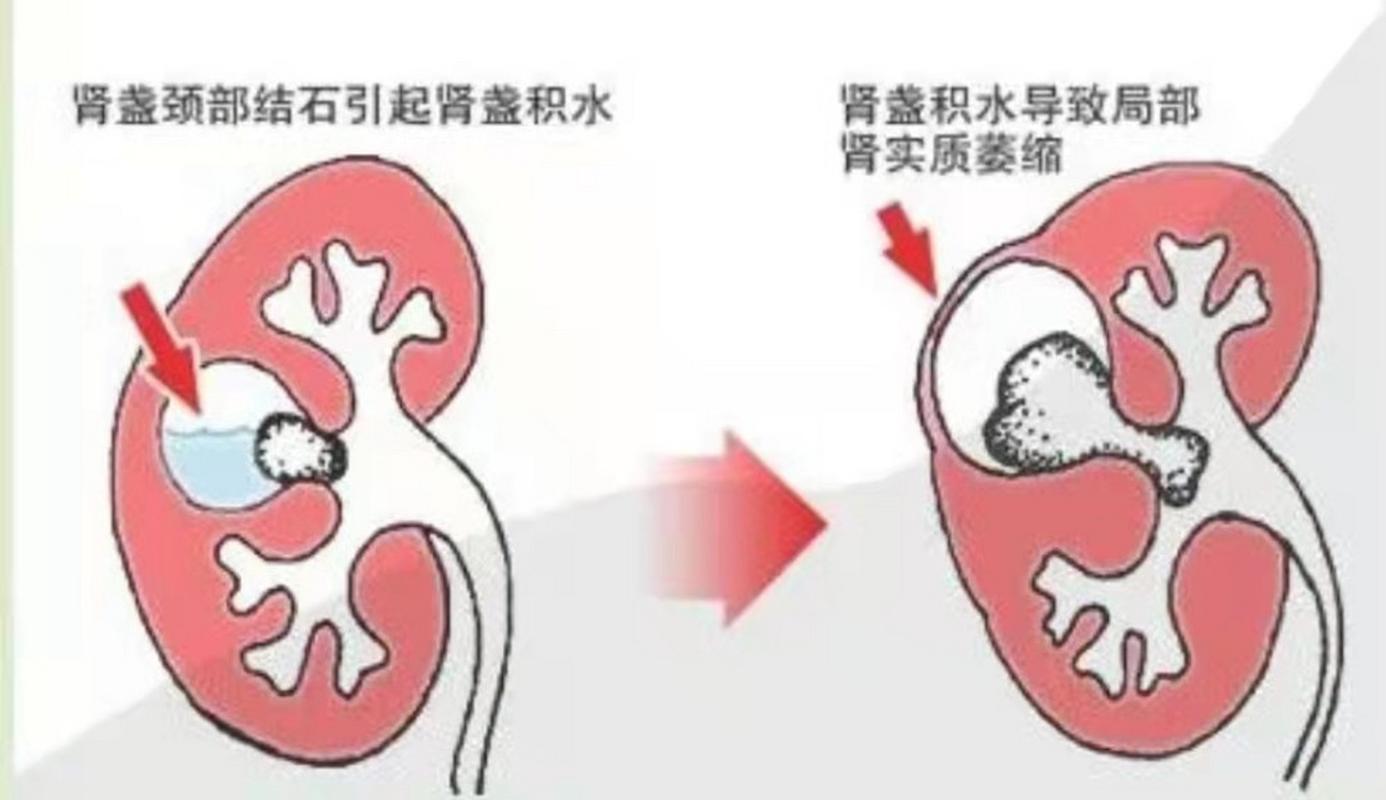 肾结石对身体有什么影响