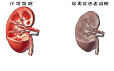 得尿毒症是什么症状