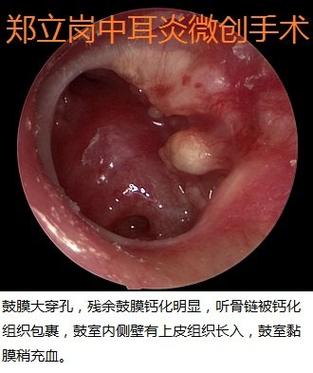 哪些中耳炎需要手术治疗